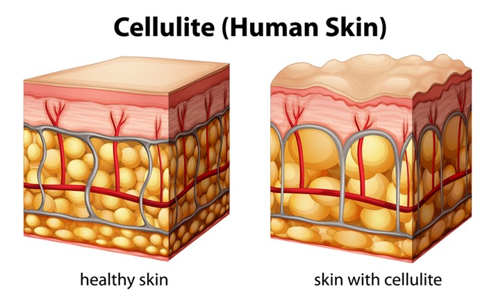 健康な人とセルライトの人の肌や細胞の違い